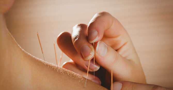 Acupuncture