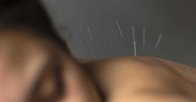 Exploring the advantages of Acupuncture